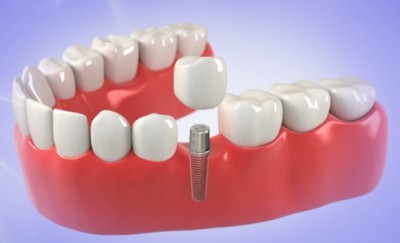 Fullerton Dental Implants